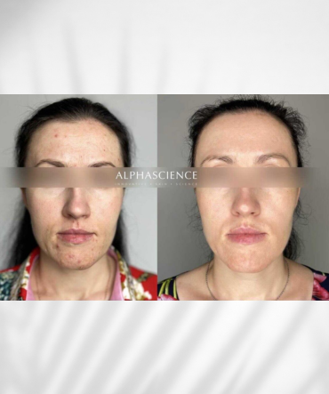 MontagePYTICSerum_370x500px.png