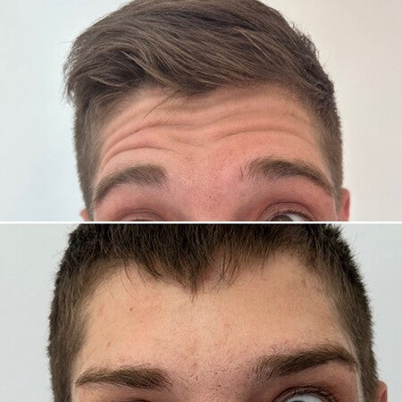 avant_apres_botox_quebec.jpg